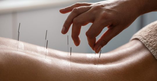 Acupuntura: Un Camino Natural hacia el Bienestar y la Salud Integral